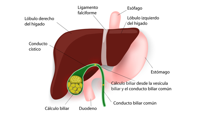 Colelitiasis