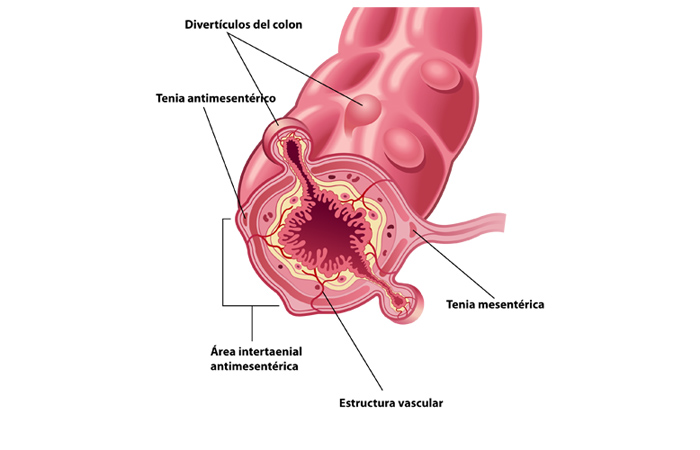 Divertículos de colon