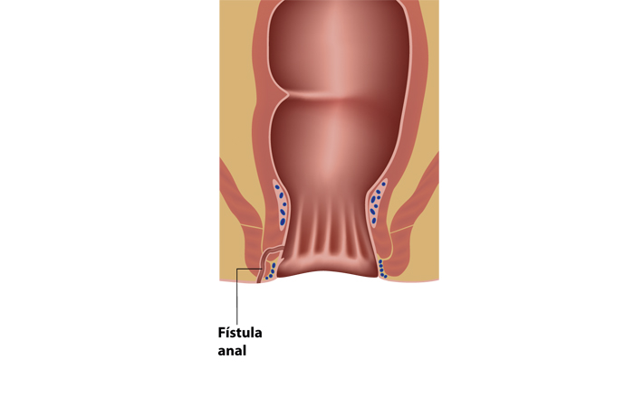 Fístula de ano