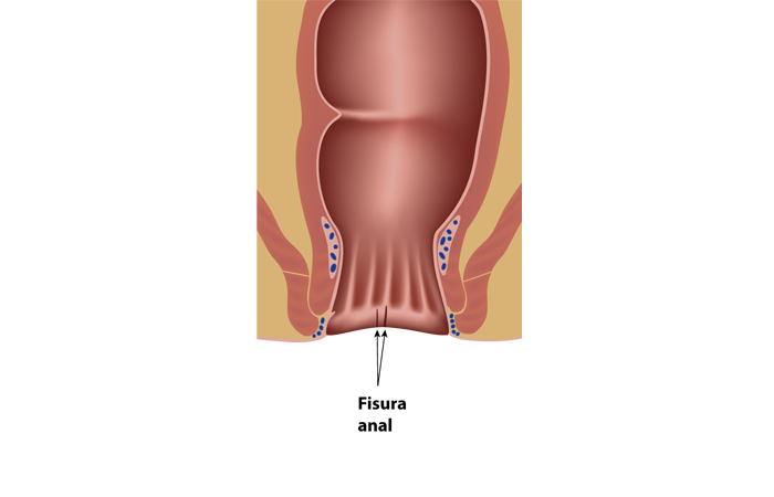 Fisura anal