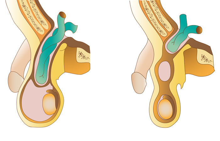 Hernias inguinales